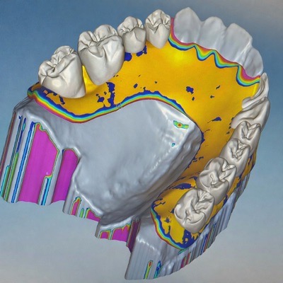 Digitale CAD-Konstruktion eines Zahnersatzes