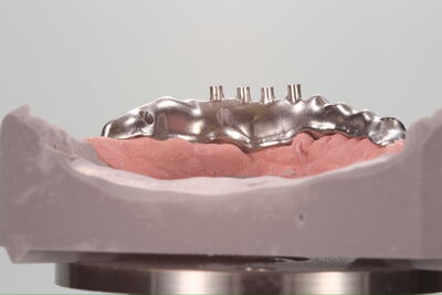 Gefräster I-Bar Implantatsteg auf Unterkiefermodell
