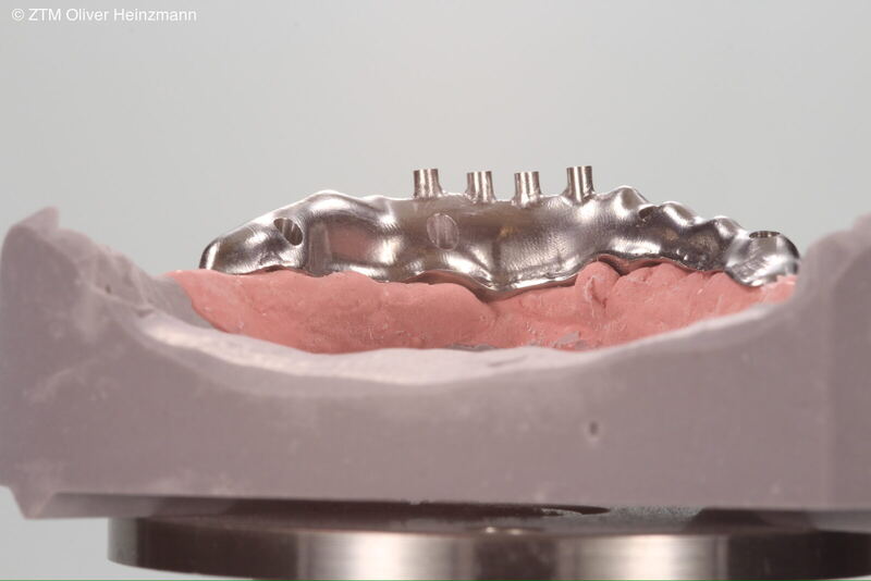 Gefräster I-Bar Implantatsteg auf Unterkiefermodell