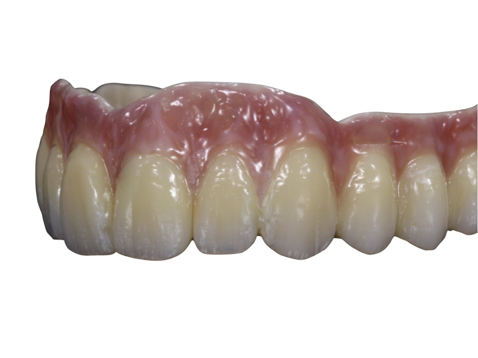 Herausnehmbarer Zahnersatz – Implantatgetragene Prothese